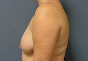 Breast Augmentation with Lift Before and After Pictures Nashville, TN