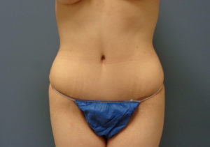 Tummy Tuck Before and After Pictures Nashville, TN