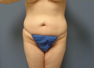 Tummy Tuck Before and After Pictures Nashville, TN