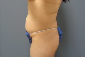 Tummy Tuck Before and After Pictures Nashville, TN