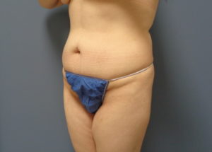 Tummy Tuck Before and After Pictures Nashville, TN