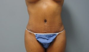 Tummy Tuck Before and After Pictures Nashville, TN