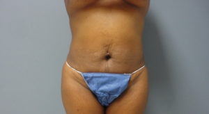 Tummy Tuck Before and After Pictures Nashville, TN