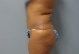 Tummy Tuck Before and After Pictures Nashville, TN