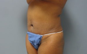 Tummy Tuck Before and After Pictures Nashville, TN