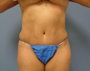 Tummy Tuck Before and After Pictures Nashville, TN