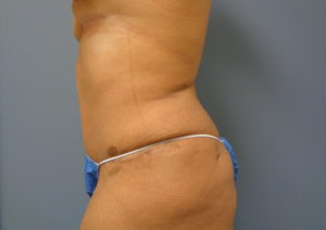 Tummy Tuck Before and After Pictures Nashville, TN