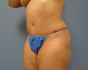 Tummy Tuck Before and After Pictures Nashville, TN