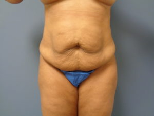 Tummy Tuck Before and After Pictures Nashville, TN