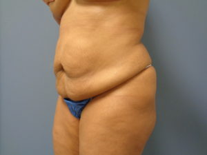 Tummy Tuck Before and After Pictures Nashville, TN