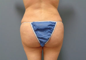 Butt Augmentation Before and After Pictures Nashville, TN