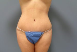 Tummy Tuck Before and After Pictures Nashville, TN