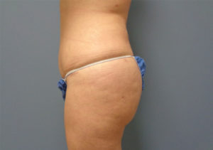 Butt Augmentation Before and After Pictures Nashville, TN