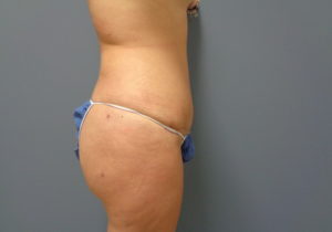 Tummy Tuck Before and After Pictures Nashville, TN