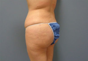 Butt Augmentation Before and After Pictures Nashville, TN