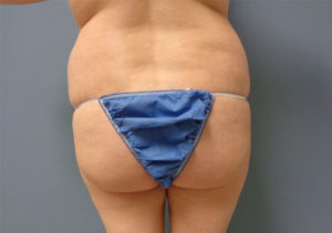 Butt Augmentation Before and After Pictures Nashville, TN