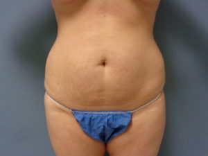 Tummy Tuck Before and After Pictures Nashville, TN