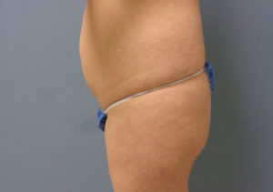 Butt Augmentation Before and After Pictures Nashville, TN