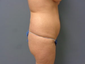 Tummy Tuck Before and After Pictures Nashville, TN