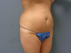 Tummy Tuck Before and After Pictures Nashville, TN