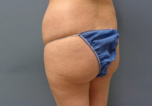 Butt Augmentation Before and After Pictures Nashville, TN