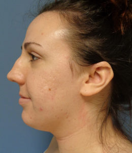 Rhinoplasty Before & After Pictures in Nashville, TN