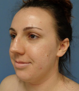 Rhinoplasty Before & After Pictures in Nashville, TN