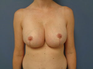 Breast Augmentation with Lift Before and After Pictures Nashville, TN