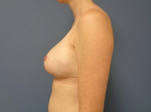 Breast Augmentation with Lift Before and After Pictures Nashville, TN