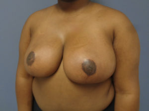 Breast Reduction Before and After Pictures Nashville, TN