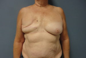 Implant Based Reconstruction Before and After Pictures Nashville, TN