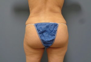 Butt Augmentation Before and After Pictures Nashville, TN