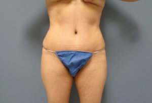 Tummy Tuck Before and After Pictures Nashville, TN