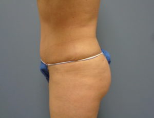 Butt Augmentation Before and After Pictures Nashville, TN