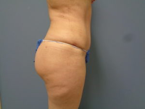 Tummy Tuck Before and After Pictures Nashville, TN