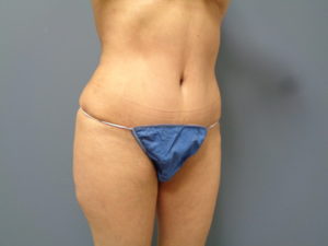 Tummy Tuck Before and After Pictures Nashville, TN