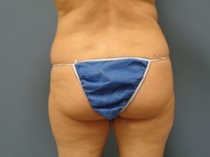 Butt Augmentation Before and After Pictures Nashville, TN