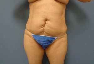 Tummy Tuck Before and After Pictures Nashville, TN