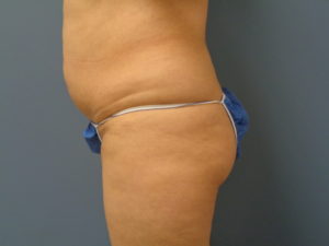 Butt Augmentation Before and After Pictures Nashville, TN