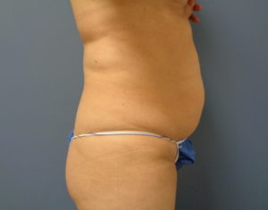 Tummy Tuck Before and After Pictures Nashville, TN