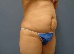 Tummy Tuck Before and After Pictures Nashville, TN