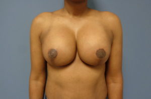 Breast Augmentation with Lift Before and After Pictures Nashville, TN