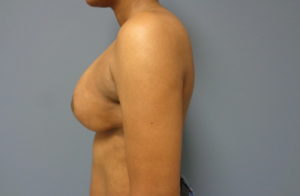 Breast Augmentation with Lift Before and After Pictures Nashville, TN