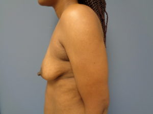 Breast Augmentation with Lift Before and After Pictures Nashville, TN