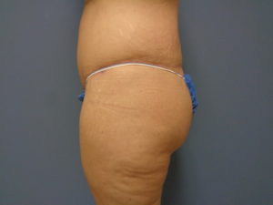 Butt Augmentation Before and After Pictures Nashville, TN