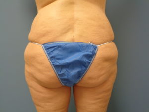 Butt Augmentation Before and After Pictures Nashville, TN