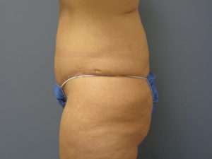 Butt Augmentation Before and After Pictures Nashville, TN