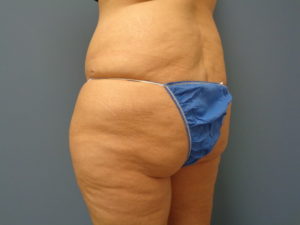 Butt Augmentation Before and After Pictures Nashville, TN