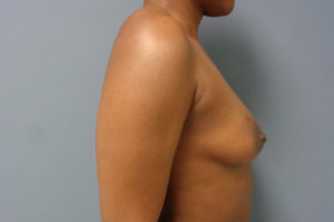 Breast Augmentation Before and After Pictures Nashville, TN