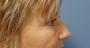 Blepharoplasty Before and After Pictures Nashville, TN